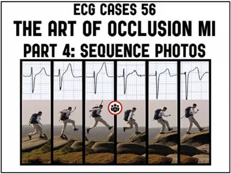 Jesse McLaren (@ecgcases) on Twitter photo #ECG Cases 56: the art of #OcclusionMI, part 4: sequence photos
emergencymedicinecases.com/ecg-cases-art-…
<a href="/EMCases/">Anton Helman</a> <a href="/heartsECGcourse/">heartsECGcourse</a>
#FOAMed #EKG #cardiotwitter #ECG Cases 56: the art of #OcclusionMI, part 4: sequence photos
emergencymedicinecases.com/ecg-cases-art-…
<a href="/EMCases/">Anton Helman</a> <a href="/heartsECGcourse/">heartsECGcourse</a>
#FOAMed #EKG #cardiotwitter