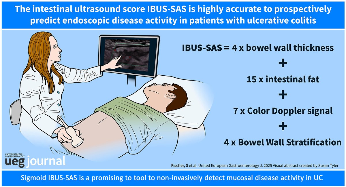 UEGJournal's tweet photo. 🩻🩺 #IBUS-SAS, an intestinal ultrasound score, correlates with endoscopic, histologic & biomarker activity in #UlcerativeColitis
With 100% sensitivity & performance similar to the Nancy index, it’s a promising non-invasive biomarker
📖 #OpenAccess 👉 https://t.co/YHvrZ421yk https://t.co/LXcGzd8PTQ