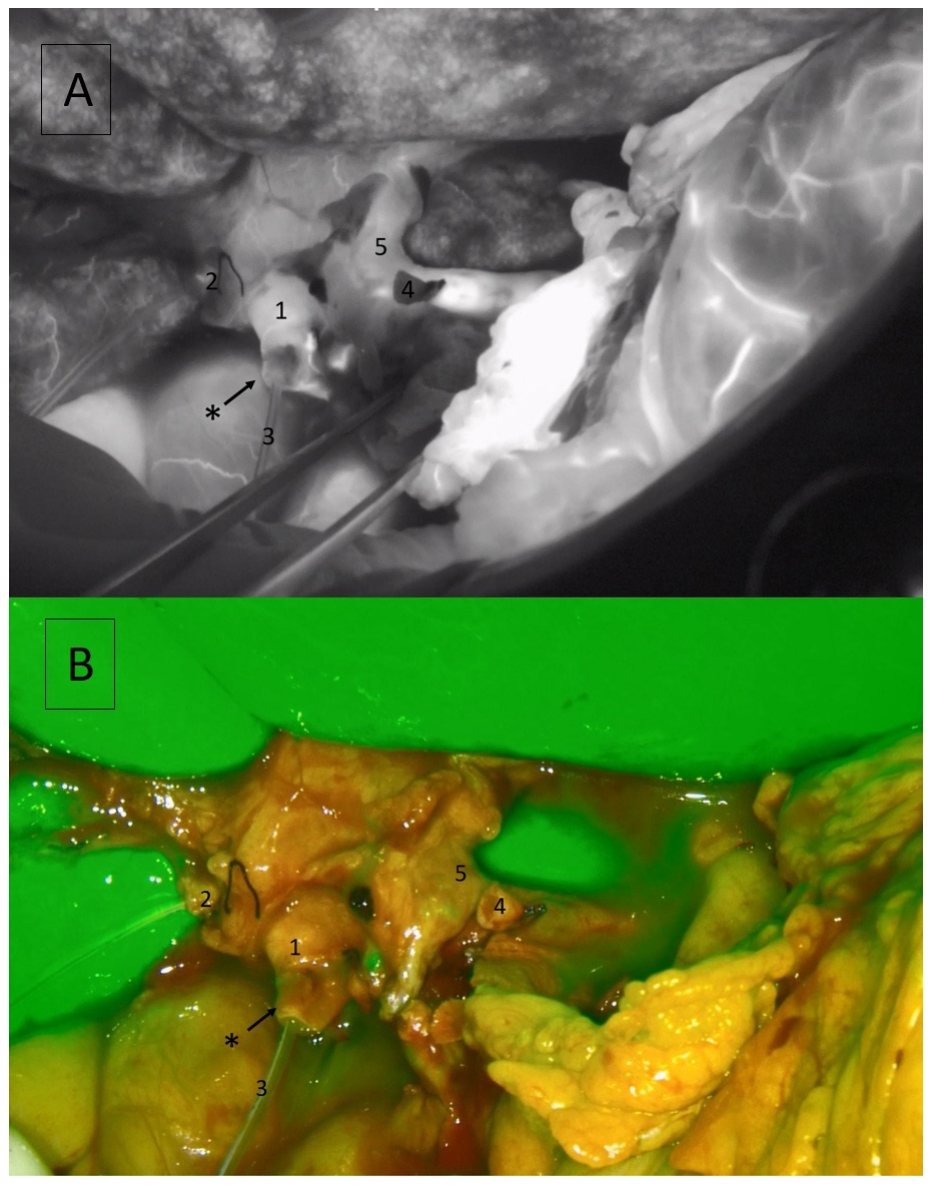 Just published in BMJ-SIT <a href="/bmj_latest/">The BMJ</a> !!💡 Brightening the path to safe liver transplants: the role of ICG fluorescence in biliary anastomosis.  Another great use of ICG to make Liver Transplantation even safer.
Thanks to the whole <a href="/vallhebron/">Vall d'Hebron</a> team!! sit.bmj.com/content/bmjsit…