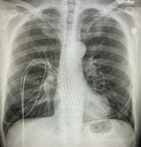 Emergency Medicine Case Challenge:
Pleuritic Chest Pain
erpocketbooks.com/xr1/