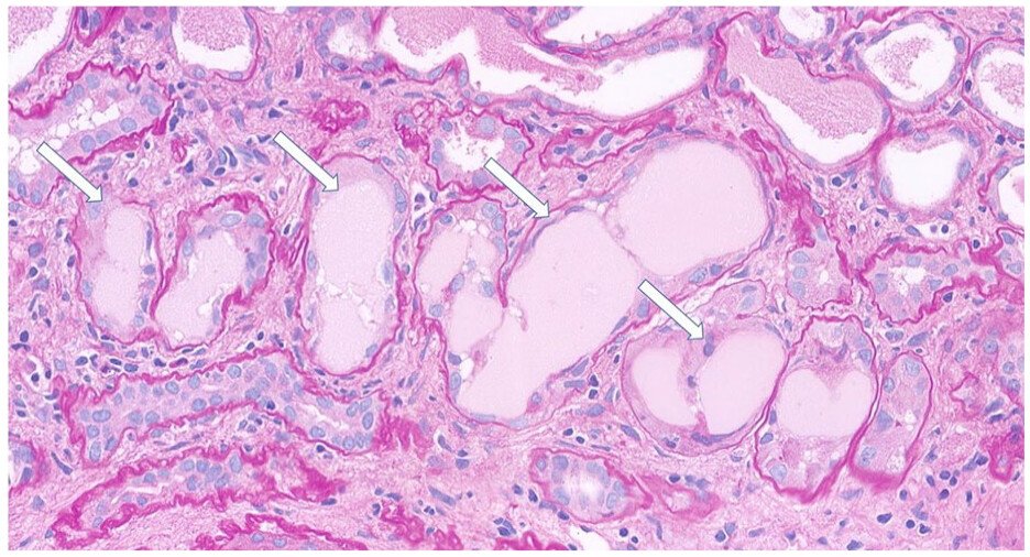A patient presented with severe #AKI and no other symptoms. A #biopsy revealed cast nephropathy. Bone marrow biopsy ultimately led to a diagnosis of #ExtranodalMarginalZoneLymphoma 
<a href="/lampanghospital/">Lampang Hospital</a> <a href="/CSNSCN/">CSN</a> <a href="/CanJKHD/">CJKHD</a> 

doi.org/10.1177/205435…
