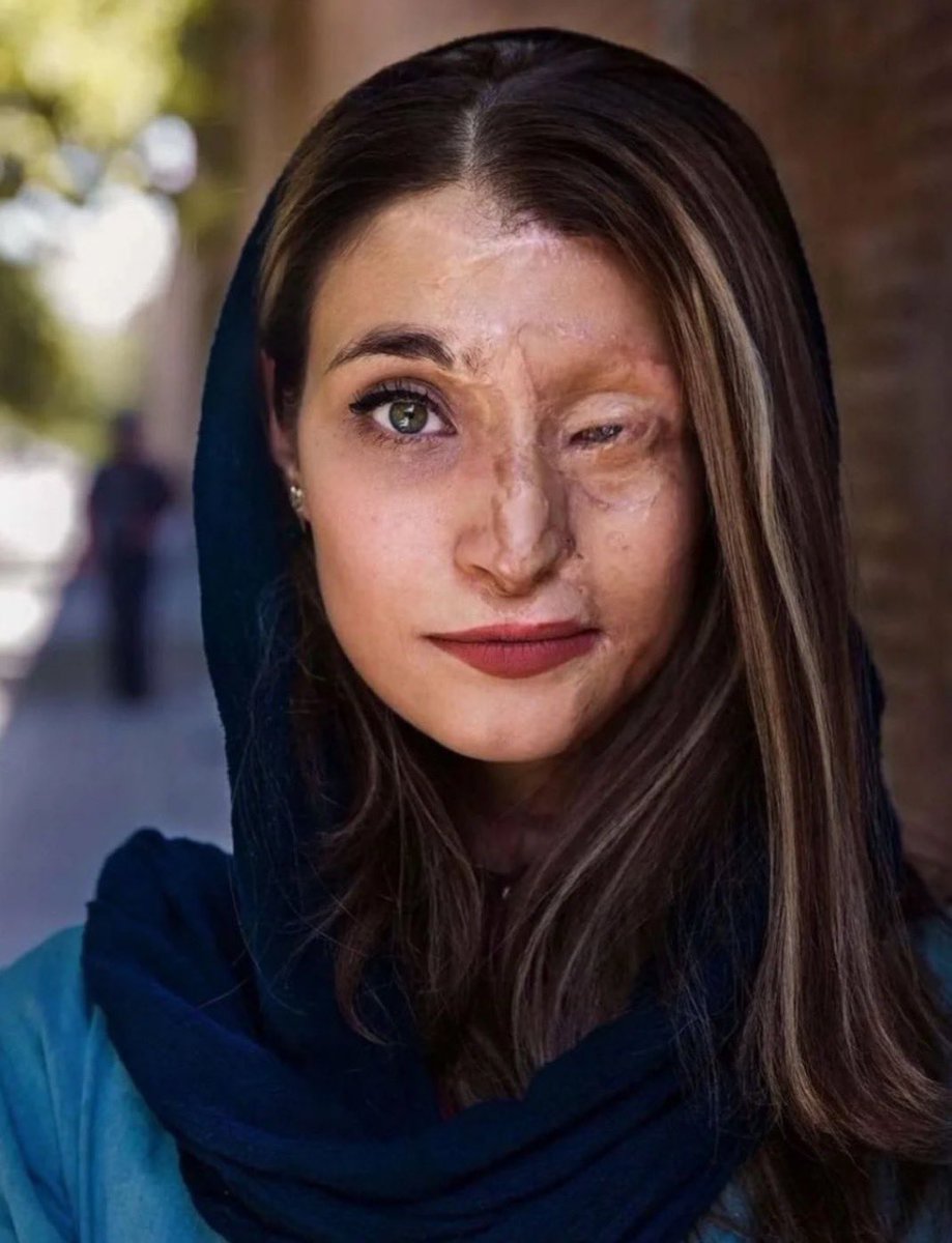 Marzieh Ebrahimi foi vítima de um ataque com ácido simplesmente porque não queria usar o hijab (véu ou lenço) usada pelas mulheres muçulmanas.
Esta é a vida das mulheres iranianas sob o regime islâmico. 
Os esquerdistas do Bostil  apoia o Irã 🇮🇷