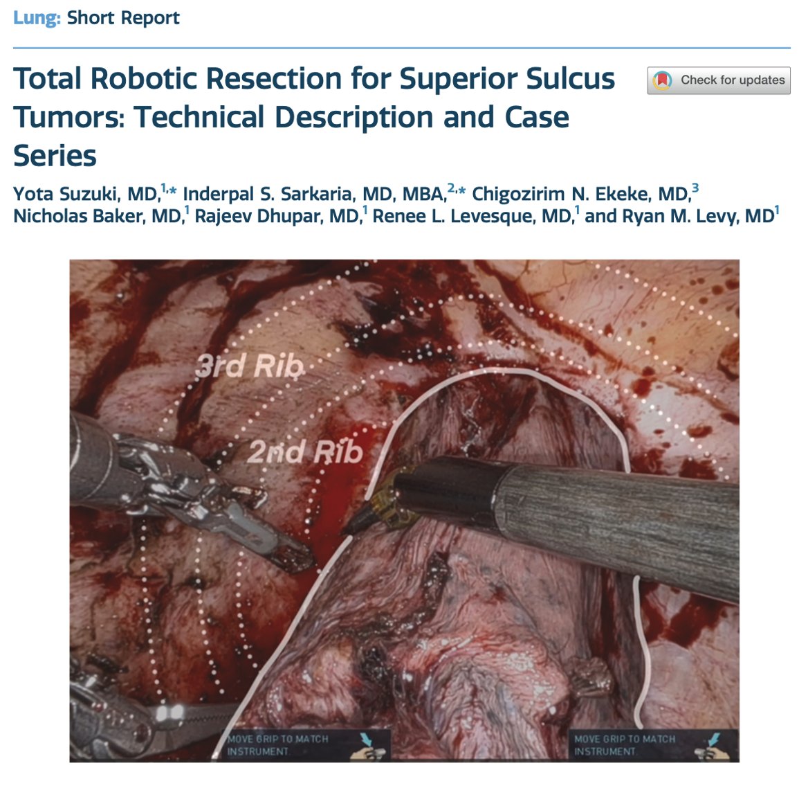 UPMC_CTSurgery's tweet image. Case series demonstrates that total robotic resection of superior sulcus tumors appears to be feasible and safe
🔗📹: pubmed.ncbi.nlm.nih.gov/40525146/
@yosuzukimd @Doctor_Chigo @annalsthorsurg #CaseSeries #ShortReports #RoboticSurgery