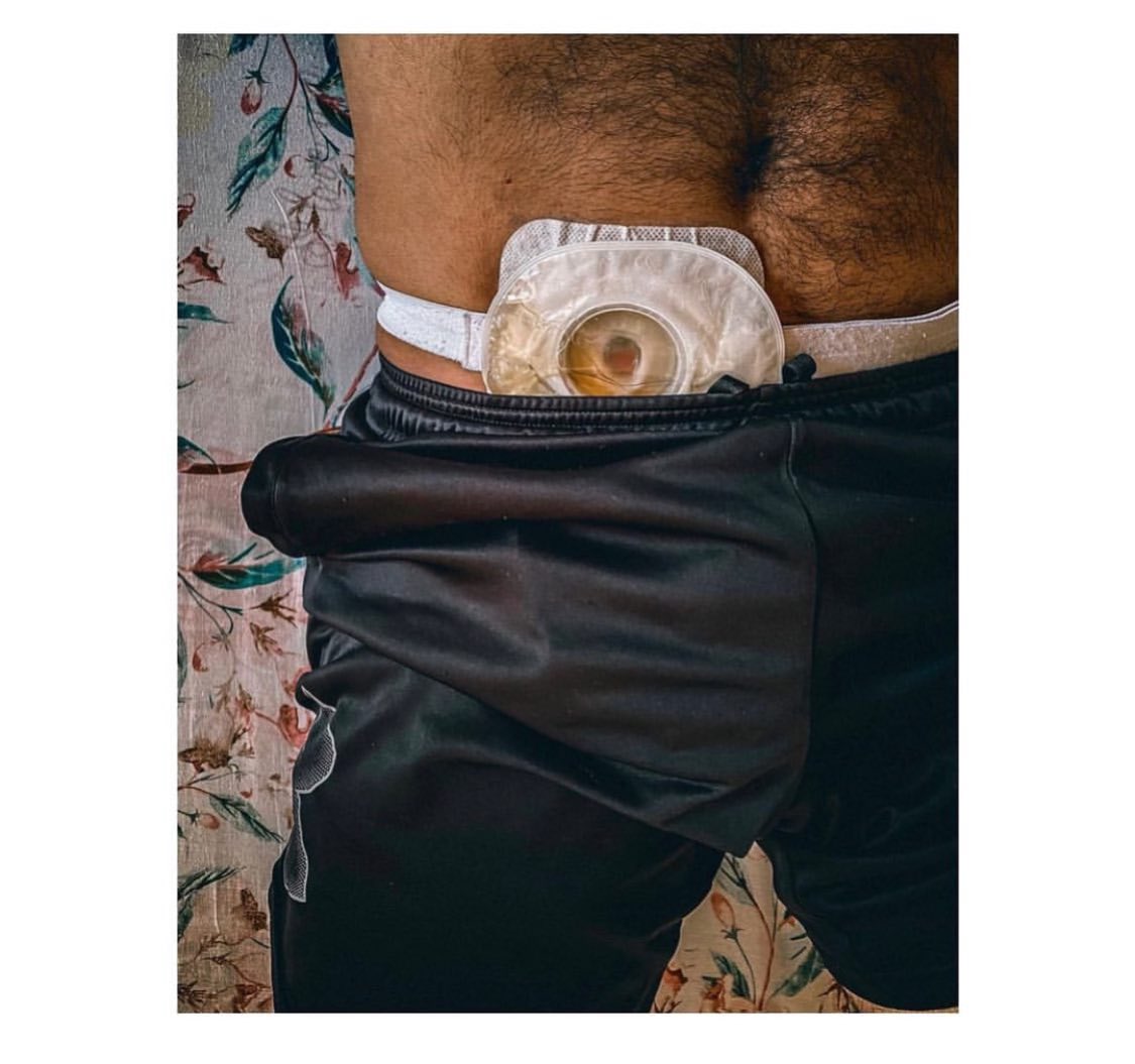 GustavoMunozJ's tweet photo. 💧Mi bolsa de urostomía es como una alarma silenciosa:
no suena, se llena… y me recuerda que sigo vivo.
#Urostomía #VisibleLoInvisible #YoElijoVivir https://t.co/ZOfrcEfDD5