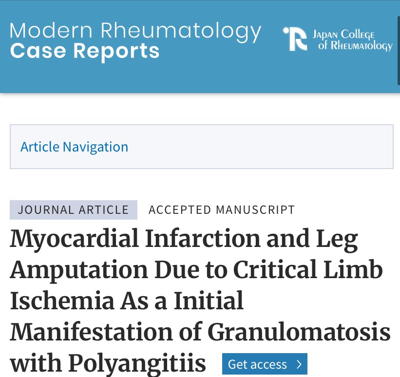 Sim_Orizon's tweet image. 🧐Granulomatosis with polyangiitis #GPA can present as a diagnostic emergency.A multidisciplinary approach led to timely treatment despite no initial biopsy. Later confirmation: necrotizing vasculitis.Teamwork saves lives.😎
👉🏼urly.it/31b8f2 👀
#vasculitis #rheumatology