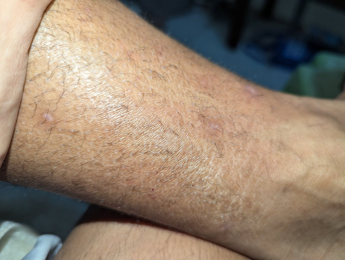 9thofJuly__'s tweet photo. Suspected ichthyosis (fish scale-like itchy skin). Anyone else experiencing this? 

Even before I knew I was poz, I already felt persistent itchiness in this part of my legs. 

When I got my diagnosis, I thought maybe it was one of the manifestations. https://t.co/KwRtZ3IbcW