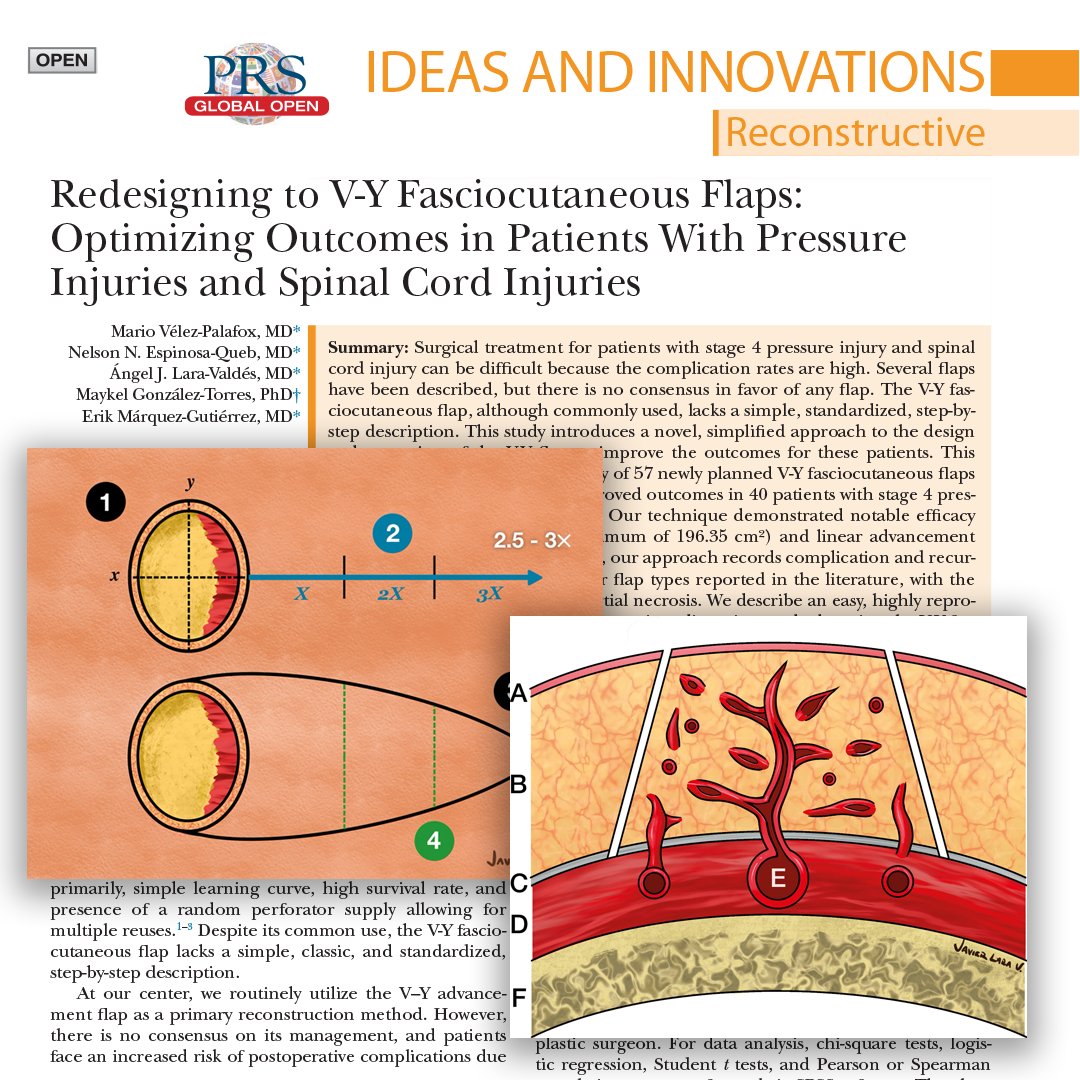 PRSGlobalOpen's tweet image. 🩺 Treating stage 4 pressure injuries in spinal cord injury patients is tough—but this new study may change the game.
Discover a simple, step-by-step V-Y flap technique that covers large defects with low complication rates and no necrosis.
📖 Read it FREE: l8r.it/7yKZ