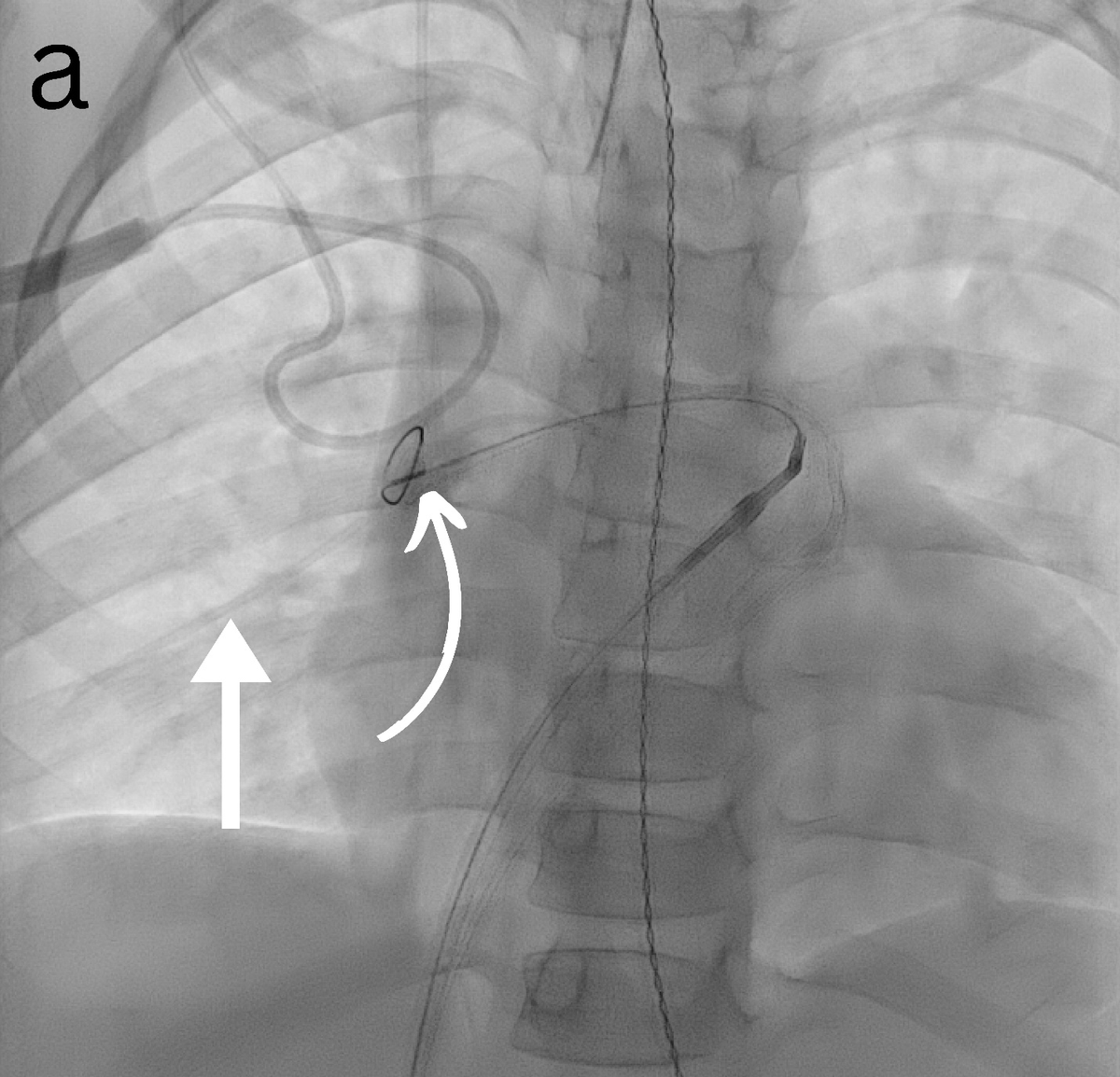 InvasiveCardiol's tweet image. June Original Article: Percutaneous Removal of Pulmonary Intravascular Foreign Bodies in Children ▶️ hubs.ly/Q03tcDMg0
@DLBHATTMD #cardioTwitter #cardioX #cardiology #interventionalcardiology