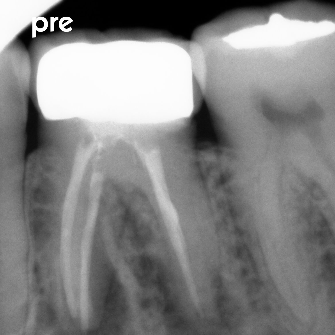dentist_amar617's tweet image. Re-RCt for lower 1st molar #36 diagnosed with apical periodonditis GP removed,patency gaind and canal shaped  filled with Gp and bio-sealer 
علاج عصب لطاحن  سفلي ازالة التلبيسة القديمة واكمال علاج العصب ووضع  تلبيسة مؤقتة لمتابعة الحالة 
#saveatooth