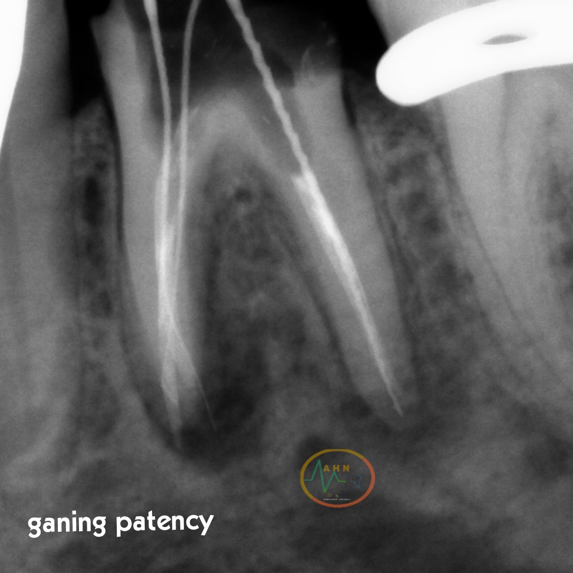dentist_amar617's tweet image. Re-RCt for lower 1st molar #36 diagnosed with apical periodonditis GP removed,patency gaind and canal shaped  filled with Gp and bio-sealer 
علاج عصب لطاحن  سفلي ازالة التلبيسة القديمة واكمال علاج العصب ووضع  تلبيسة مؤقتة لمتابعة الحالة 
#saveatooth