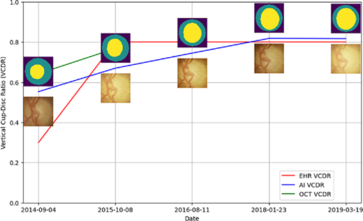 TVST Journal (@arvotvst) on Twitter photo Jayashree Kalpathy-Cramer et al. <a href="/CUEyeCenter/">CU Ophthalmology</a> develop an artificial intelligence optic cup and disc segmentation pipeline for obtaining optic nerve head measurements from fundus images and externally validate performance against OCT measurements.
doi.org/10.1167/tvst.1… Jayashree Kalpathy-Cramer et al. <a href="/CUEyeCenter/">CU Ophthalmology</a> develop an artificial intelligence optic cup and disc segmentation pipeline for obtaining optic nerve head measurements from fundus images and externally validate performance against OCT measurements.
doi.org/10.1167/tvst.1…