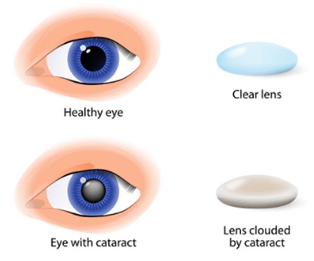 Ontario Health Minister Sylvia Jones says contracting cataract surgeries to private clinics is working to reduce wait times. Truth is wait times have worsened, everyone but the wealthy have lost access and costs have doubled.