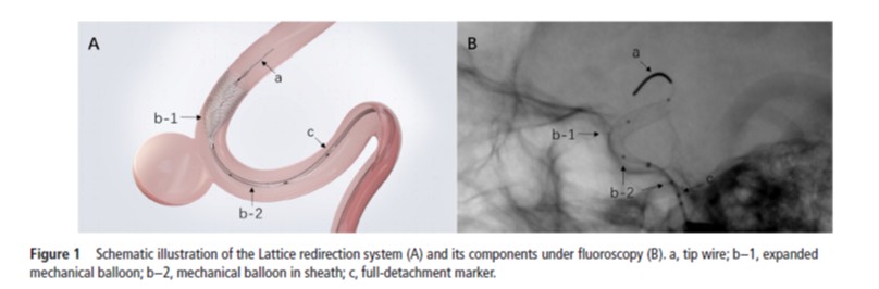 New device technology alert!  A novel balloon-based flow diverter demonstrates an excellent performance and safety profile bit.ly/4l9oggd #FlowDiverter #MedicalInnovation #EndovascularSurgery #MedicalDevices
