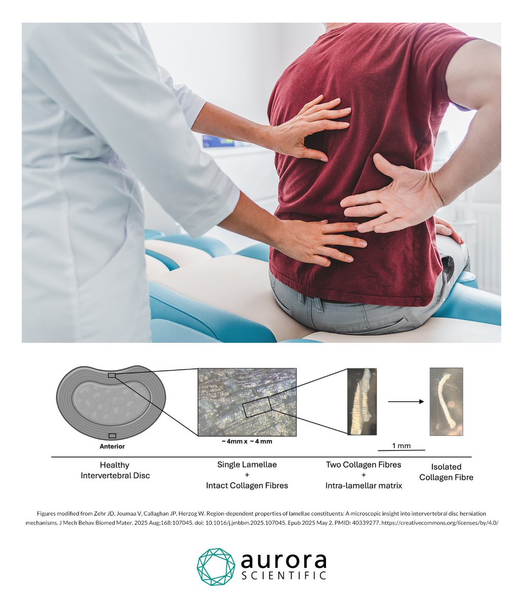Aurora Scientific (@aurorasci) on Twitter photo New study by <a href="/JackieZehr/">Jackie Zehr</a> revealed region-specific differences in lamellar fiber mechanics linked to disc herniation risk. Researchers showed how microstructural stiffness variations in the annulus fibrosus impact failure patterns. #AuroraScientific #1400A
doi.org/10.1016/j.jmbb… New study by <a href="/JackieZehr/">Jackie Zehr</a> revealed region-specific differences in lamellar fiber mechanics linked to disc herniation risk. Researchers showed how microstructural stiffness variations in the annulus fibrosus impact failure patterns. #AuroraScientific #1400A
doi.org/10.1016/j.jmbb…