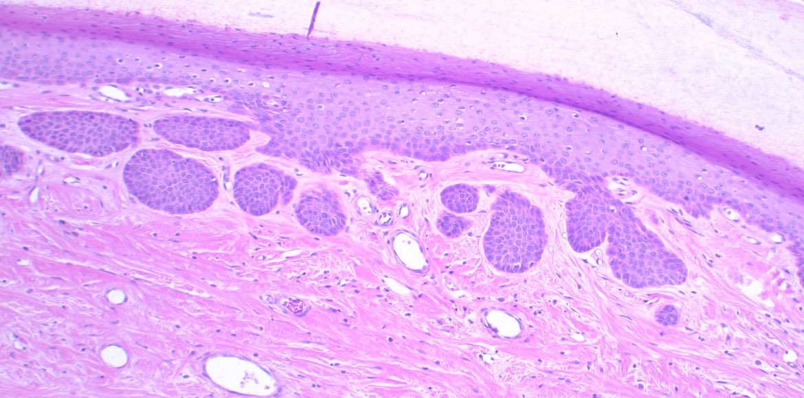 #nail #histology

Intermediate matrix can show oblique rete ridges

There is no cytological atypia

Please, do not call it carcinoma 🚫⛔️

#path #pathology #patología #dermpath #dermatopathology