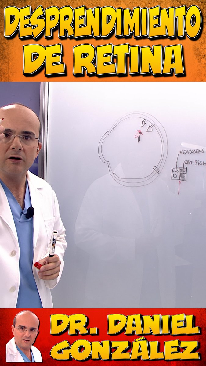 DocDanielGlez's tweet photo. Si le interesa saber los aspectos más importantes del #desprendimientoderetina ¡no deje de ver este vídeo!
https://t.co/0esNngCWpw https://t.co/dMb21wJdP0