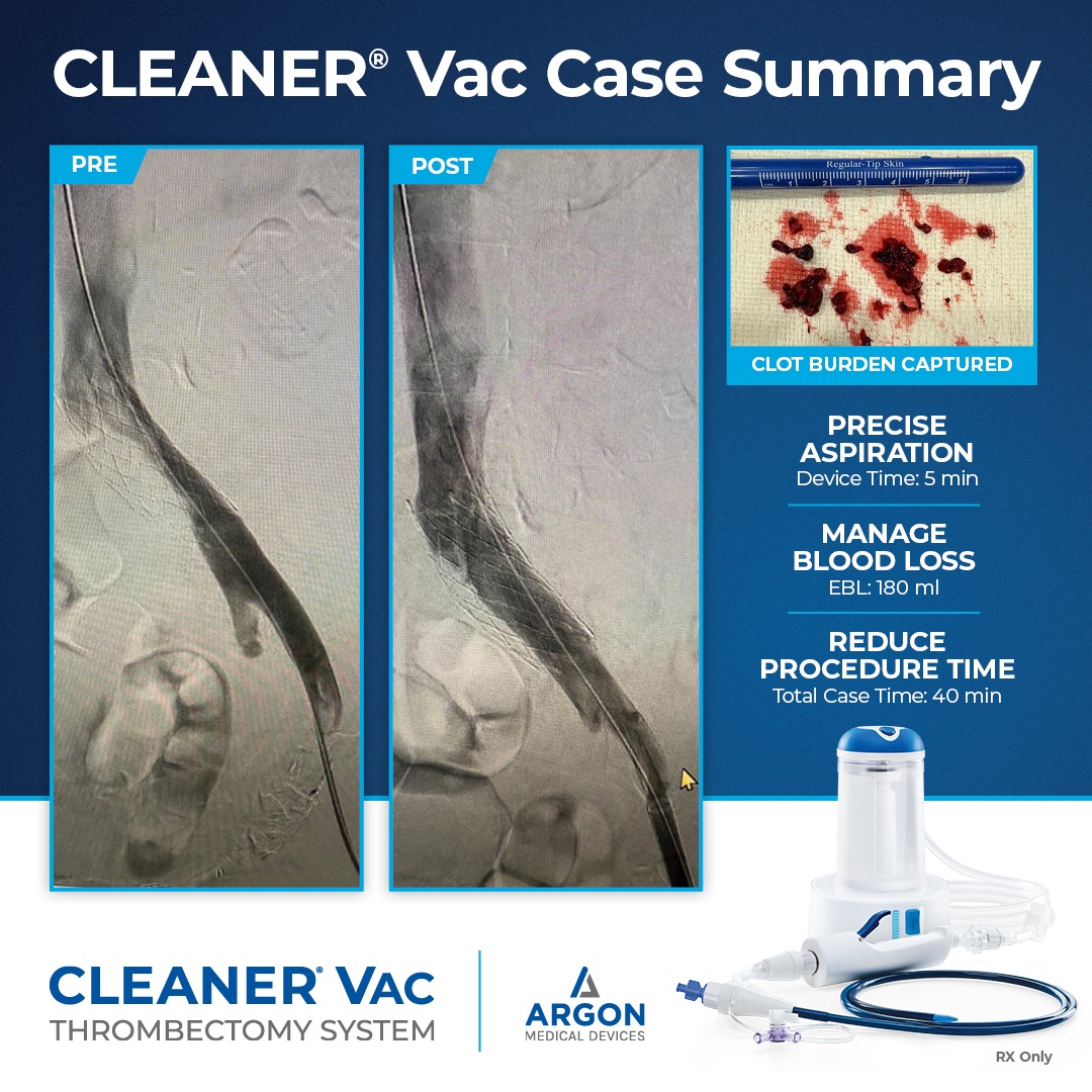 ArgonMedical's tweet image. The CLEANER Vac® Thrombectomy System is designed to deliver precise aspiration, efficient clot removal, and time-saving performance - all while managing blood loss.
Case results from Dr. @ZJBD_MD offer a closer look at CLEANER Vac in action.
Ready to take control?…