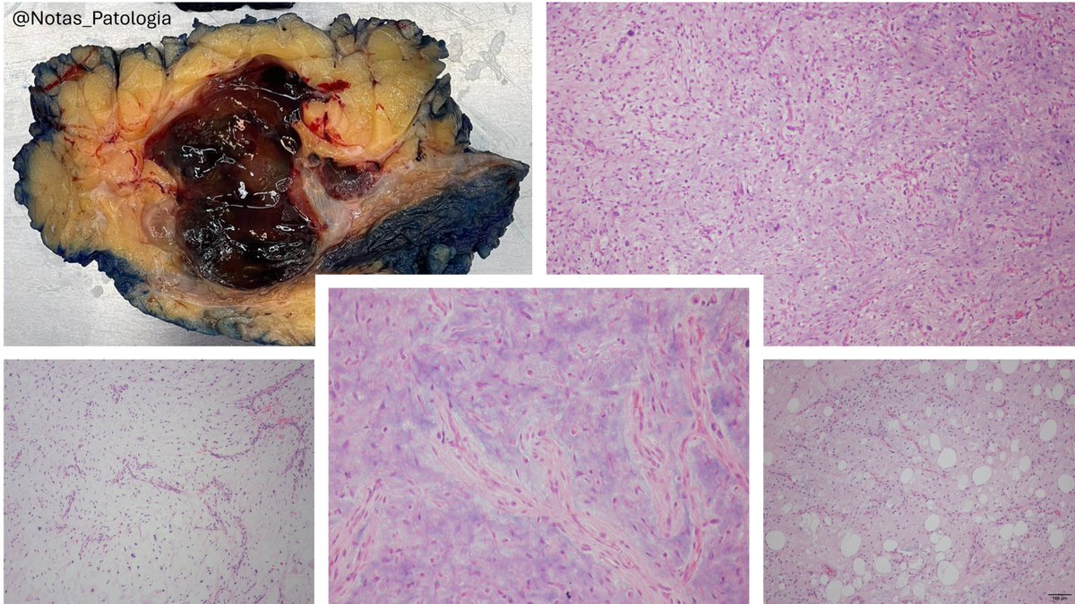 Notas_Patologia's tweet photo. 🍓 "Strawberry Gelatinous Appearance" — A Possible Face of Myxoid Liposarcoma

Myxoid liposarcoma (MLS) is one of the most morphologically distinctive soft tissue sarcomas, both microscopically and macroscopically. In some cases, it displays the so-called "strawberry gelatinous appearance" — a reddish-pink, translucent, gelatinous cut surface, sometimes with hemorrhagic areas. Although not a constant finding, this pattern reflects the tumor’s rich myxoid matrix and delicate vasculature, and is appreciated by pathologists as a suggestive clue, though not pathognomonic.

🔬 Overview

Accounts for approximately 30–40% of liposarcomas in adults

Peak incidence: 3rd to 5th decade
Most common sites: deep soft tissues of the thigh and retroperitoneum
🧠 Classic Histology

Abundant myxoid stroma rich in hyaluronic acid

Delicate branching capillaries in a “chicken-wire” pattern
Presence of immature lipoblasts with cytoplasmic vacuoles indenting the nucleus
May show hypercellular areas with round cells, indicating higher grade
🔎 Gross Pathology

Usually soft, gelatinous, and translucent on cut surface

In some cases, a reddish or hemorrhagic, strawberry-like appearance
While not universal, this appearance is recognized as a possible characteristic pattern
🧬 Genetics and Molecular Diagnosis

Characteristic translocation: FUS::DDIT3 (most common) or EWSR1::DDIT3

Detected by FISH, RT-PCR, or sequencing
🧪 Immunohistochemistry

S100: may be positive in lipoblasts

CD34 and MDM2: generally negative
Note: Diagnosis is primarily based on morphology and molecular findings
📉 Prognosis and Risk Factors

A round cell component >5% is associated with worse prognosis

Metastases more commonly occur in soft tissues, bones, and retroperitoneum (less commonly in the lungs)
Purely myxoid tumors tend to have a more favorable clinical outcome
📚 References

Potterveld S, Clay MR. Myxoid liposarcoma. https://t.co/yteSms2T6w website. Available at: https://t.co/CoCgpiSCMS. Accessed June 24th, 2025.

WHO Classification of Tumours Editorial Board. Soft Tissue and Bone Tumours. 5th ed. Lyon: IARC; 2020.
Antonescu CR. The role of genetics in the diagnosis of soft tissue tumors. Mod Pathol. 2014;27(Suppl 1):S36–S43.

⚠️ Disclaimer: This content is intended for educational purposes only and should not be considered a substitute for professional medical advice, diagnosis, or treatment.

#MedicalEducation #NotasDePatologia #SoftTissuePathology #MyxoidLiposarcoma