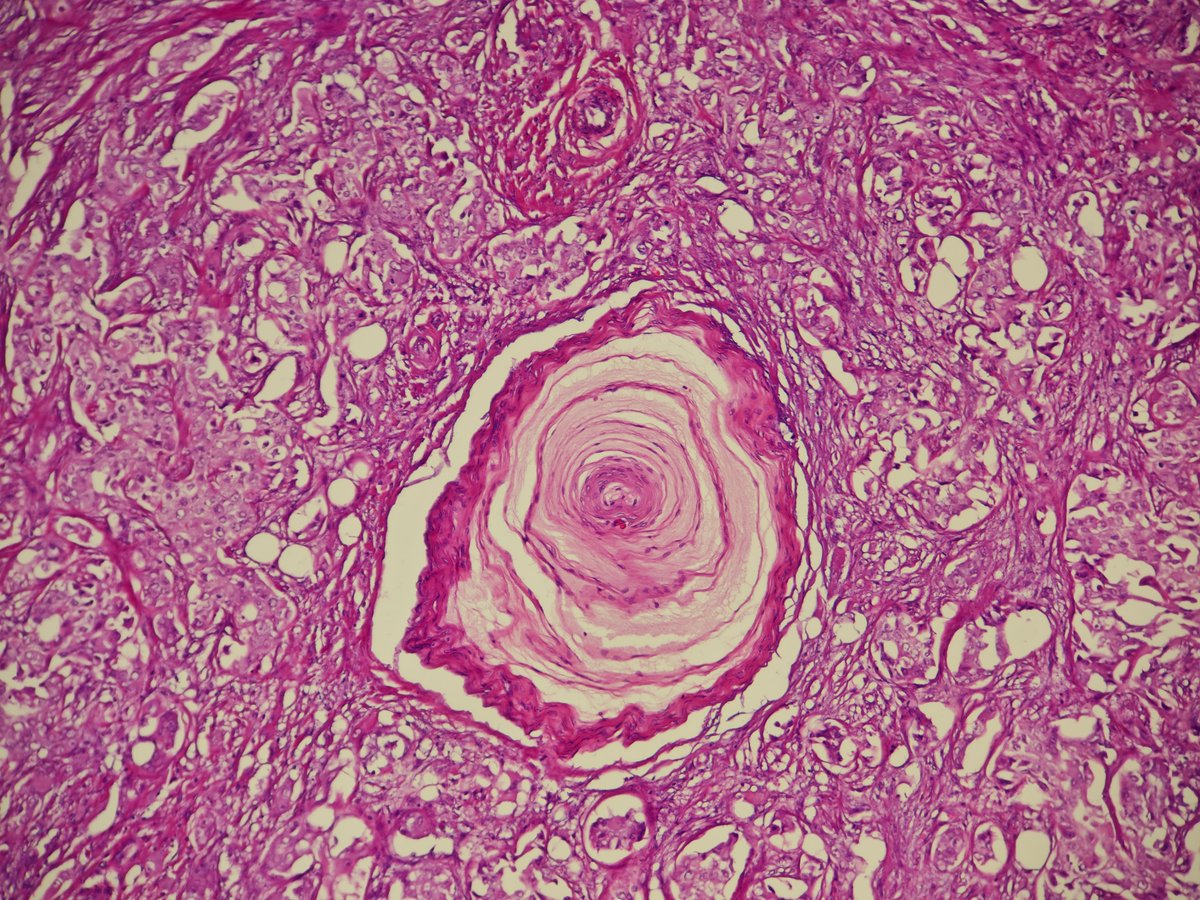 You've seen it in the prostate, now in the breast.
Breast carcinoma surrounding Pacinian corpuscle.

x.com/MirunaPopescu1…

#PathTwitter #Breastpath