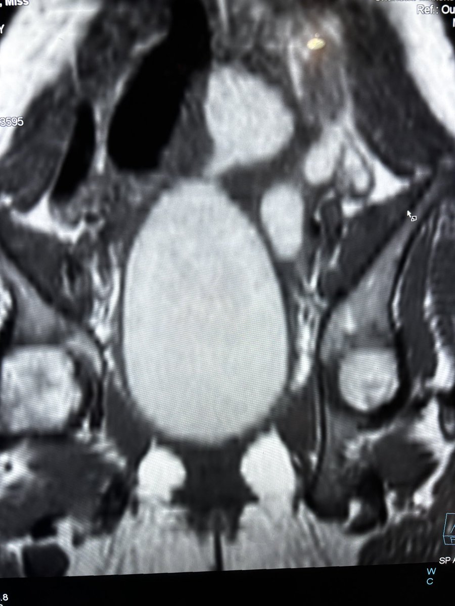 🔎 Case of the Day — Primary Amenorrhoea in an Adolescent Female

14F presenting with primary amenorrhoea, abdominal mass and cyclical pelvic pain. MRI pelvis performed to assess for Müllerian anomaly.

🧠 Key MRI (T2-weighted) findings:
🔹 Markedly distended endometrial canal