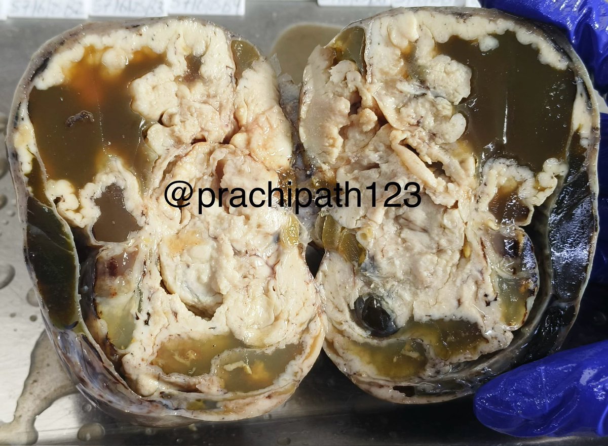 Prachi (@prachipath123) on Twitter photo Whisper of an Ovarian mass ๐โโ๏ธ
A story unfolding, a womanโs unknown truth ๐๐ป
#grossognosis
<a href="/JaredAhrendsen/">Jared T. Ahrendsen MD, PhD (AP/NP/FP)</a> <a href="/IHC_guy/">Andrew Bellizzi ๐บ๐ฆ</a> <a href="/PathologyKate/">Kathryn Lindsey</a> <a href="/pathologyguy/">Steve Davis</a> <a href="/kriyer68/">Kalyani Bambal</a> <a href="/archibhat3/">Archana bhat</a> <a href="/AmarBasharMD/">Amar Bashar</a> <a href="/adi_agnihotri/">Aditya Agnihotri ๐ฎ๐ณ</a> <a href="/VijayPatho/">Vijay Shankar S</a> <a href="/smlungpathguy/">Sanjay Mukhopadhyay</a> <a href="/PathTweetAward/">Educational Pathology Tweet Award</a>
๐ฏ Gross Diagnosis? ๐๐ป
๐ฌfollowingโฆ Whisper of an Ovarian mass ๐โโ๏ธ
A story unfolding, a womanโs unknown truth ๐๐ป
#grossognosis
<a href="/JaredAhrendsen/">Jared T. Ahrendsen MD, PhD (AP/NP/FP)</a> <a href="/IHC_guy/">Andrew Bellizzi ๐บ๐ฆ</a> <a href="/PathologyKate/">Kathryn Lindsey</a> <a href="/pathologyguy/">Steve Davis</a> <a href="/kriyer68/">Kalyani Bambal</a> <a href="/archibhat3/">Archana bhat</a> <a href="/AmarBasharMD/">Amar Bashar</a> <a href="/adi_agnihotri/">Aditya Agnihotri ๐ฎ๐ณ</a> <a href="/VijayPatho/">Vijay Shankar S</a> <a href="/smlungpathguy/">Sanjay Mukhopadhyay</a> <a href="/PathTweetAward/">Educational Pathology Tweet Award</a>
๐ฏ Gross Diagnosis? ๐๐ป
๐ฌfollowingโฆ