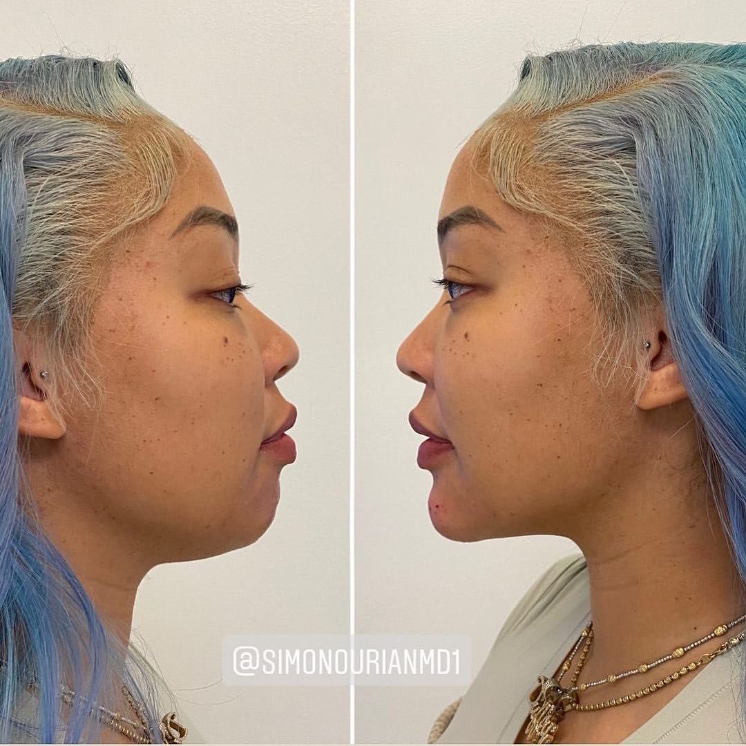 simonourianmd's tweet photo. Non-surgical chin contouring redefines your profileโno downtime, no incisions. Just beautifully balanced results.
#ChinContouring #Neustem #FacialSculpting #NonSurgicalEnhancement #Epione https://t.co/1nbzAEmwtd