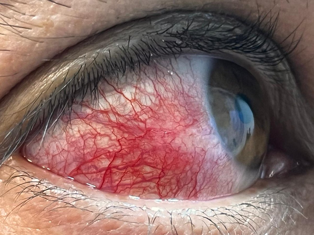 reUNma2023's tweet photo. Ojo rojo en reumatología
caso 1: Dolor articular. CCP + alto
caso2: Dolor ocular progresivo unicamente
caso3: Disfonia asociada
caso4: Xerostomia y xerodermia

Encuesta 👇👇 https://t.co/0ynDByRuDJ