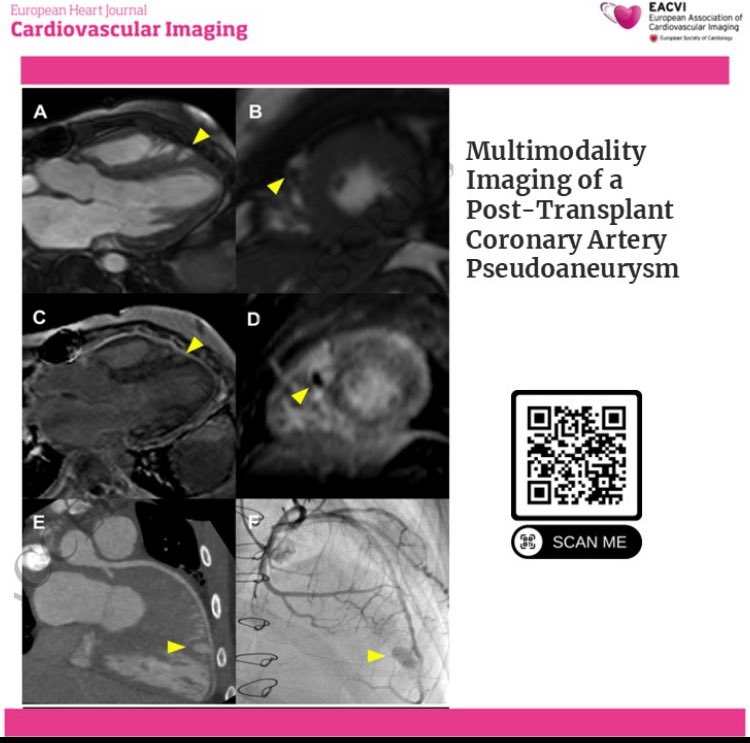 EHJCVIEiC's tweet image. #EHJCVI #imagefocus @ESC_Journals @escardio @bernhard_gerber @EACVIPresident @pabloplopez_ @echo_stepbystep @JGrapsa @MattersoftheH14 @EZancanaroMD @BenekiEirini @AnnaKateBarton