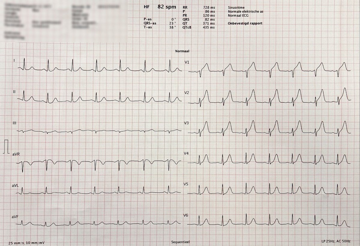 Your night shift starts with a 53-year-old diaphoretic male presenting with chest pain radiating to the left shoulder...

Is there anything concerning about this "Normal #ECG"? 🤔