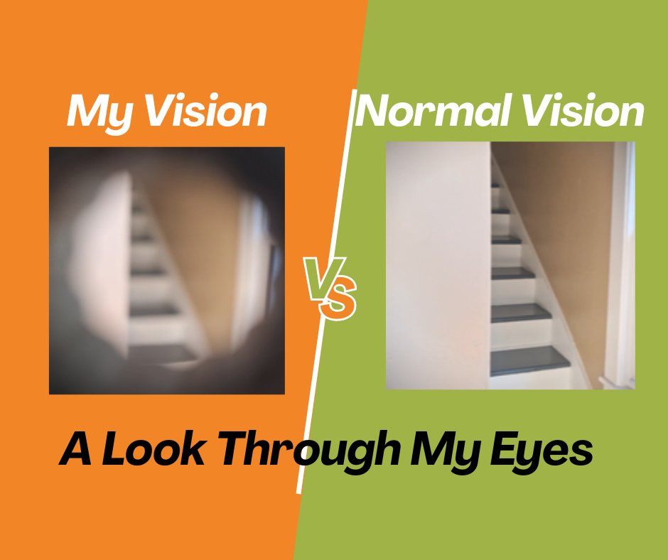 👁️ What if your world slowly narrowed… and you didn’t even notice—until it was nearly gone?

That’s what living with Retinitis Pigmentosa can feel like.

In this short video, I share a side-by-side comparison of what I see vs. what you see. It’s not meant to shock—it’s meant to