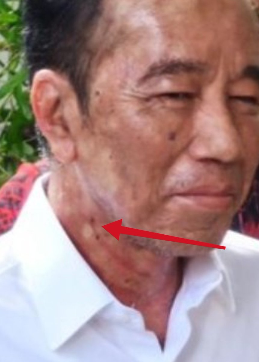 Gigitan vampir ini tidak terhapus walaupun kulit sudah mulai teroksidasi hmmm🤔