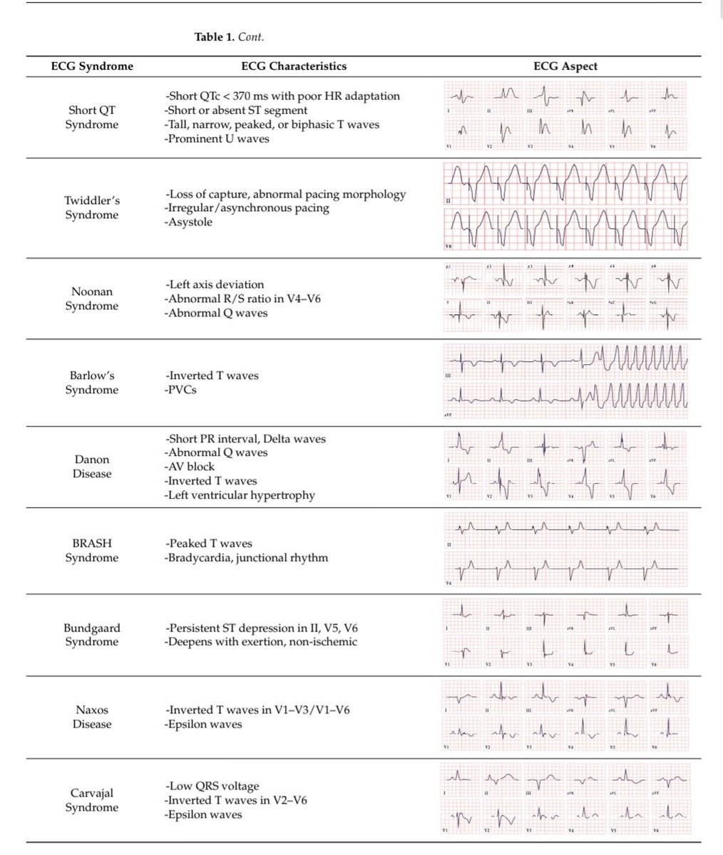 🔴Broad Electrocardiogram Syndromes Spectrum:⤵️ #2025Review #openaccess 
🔹From Common Emergencies to Particular Electrical Heart Disorders—Part II

🔹mdpi.com/2075-4418/15/1…
 #FOAMed #MedEd #medstudent #paramedic #Cardiology #CardioEd #medtwitter #meded #CardioTwitter