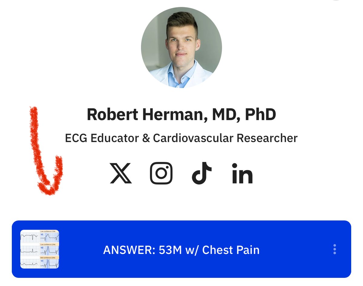 Robert Herman, MD (@roberthermanmd) on Twitter photo <a href="/smithECGBlog/">Stephen W. Smith</a> <a href="/PendellM/">Pendell Meyers</a> <a href="/DidlakeDW/">David Didlake</a> <a href="/The_Nanashi_O/">Nanashī🫀</a> <a href="/ecgandrhythmRoe/">Dr. Andreas Roeschl</a> <a href="/ecgrhythms/">Arnel Carmona</a> <a href="/EkgHacks/">ECG.Hacks</a> <a href="/FloydECGs/">Emerson Floyd</a> <a href="/EM_RESUS/">Sam Ghali, M.D.</a> <a href="/iamritu/">Ritu Thamman MD</a> I typically share the answer, including a complete clinical workup, within 48 hours.
🤫 Can’t wait that long? Check the link in my bio for the answer now! <a href="/smithECGBlog/">Stephen W. Smith</a> <a href="/PendellM/">Pendell Meyers</a> <a href="/DidlakeDW/">David Didlake</a> <a href="/The_Nanashi_O/">Nanashī🫀</a> <a href="/ecgandrhythmRoe/">Dr. Andreas Roeschl</a> <a href="/ecgrhythms/">Arnel Carmona</a> <a href="/EkgHacks/">ECG.Hacks</a> <a href="/FloydECGs/">Emerson Floyd</a> <a href="/EM_RESUS/">Sam Ghali, M.D.</a> <a href="/iamritu/">Ritu Thamman MD</a> I typically share the answer, including a complete clinical workup, within 48 hours.
🤫 Can’t wait that long? Check the link in my bio for the answer now!