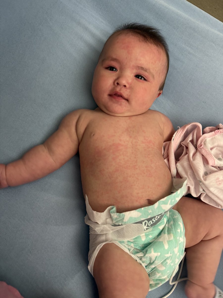 Imagine your baby was marking her 5th month… usually happy and healthy… then suddenly in-and-out of hospital. Meet Baby Kimie on <a href="/GlobalCalgary/">Global Calgary</a> at 6. She has a still uncertain outcome after, gratefully, recovering from the measles. #yyc #yeg #abmeasles