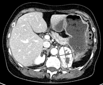 <a href="/TumorBoardTues/">#TumorBoardTuesday</a> <a href="/brian_rini/">Brian Rini, MD</a> <a href="/IntegrityCE/">Integrity CE, LLC</a> #TumorBoardTuesday #OncTwitter
70 yo 👩🏻‍🦳, F ,  ECOG 1, with recurrent RCC to Nx bed, 🫁 and LN with early-PD after Pembro/axi, and recent PD on tivozanib after 18 mo.