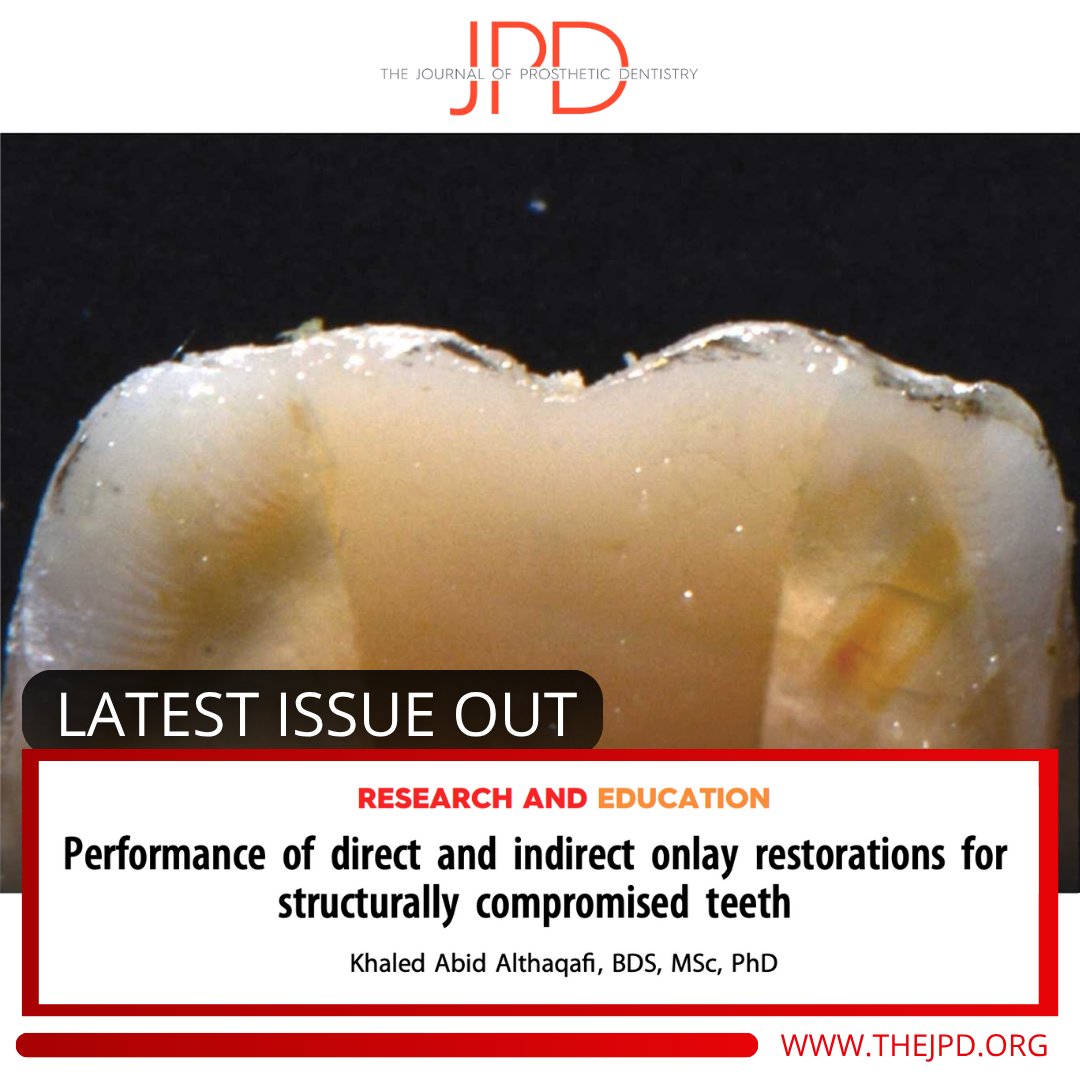 JPDentistry's tweet photo. The latest issue of #theJPD features this study that tested and compared the fracture resistance and microleakage of onlay style #dentalrestorations placed directly with #compositeresin or indirectly with #CADCAM #dentalmaterials on #teeth. Learn more: https://t.co/aztERj2Q5L https://t.co/1d8CfHNi0V