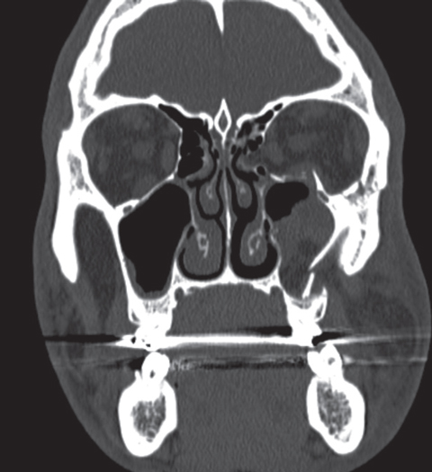 Baseball, Biking and Softball Implicated in Orbital Fractures from Sports in US

Men from the ages of 10 to 19 are the most vulnerable, and researchers call for better awareness among young athletes, parents and coaches. reviewofoptometry.com/article/baseba…
#optometry #optometrist #eyecare