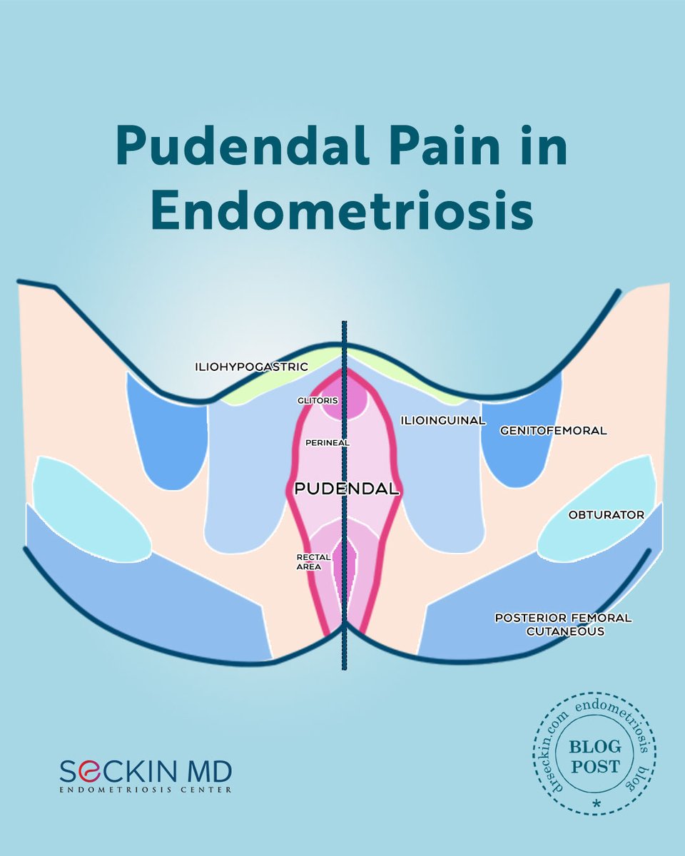 Pudendal nerve pain in endometriosis is real—and often overlooked.
Burning, stabbing pelvic pain? It might be nerve-related. drseckin.com/pudendal-pain-…

#Endometriosis #PudendalPain #PelvicPain #ChronicPain #WomensHealth #YouAreNotAlone