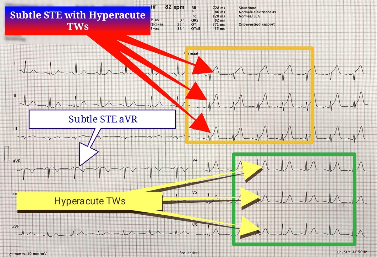 OMI signs detected‼️‼️🚑🚑

#ecg shows:

1. STE with Hyperacute TWs in V1-V3
2. Hyperacute TWs in V4-V6
3. Subtle STE aVR

🔺Acute pLAD OMI