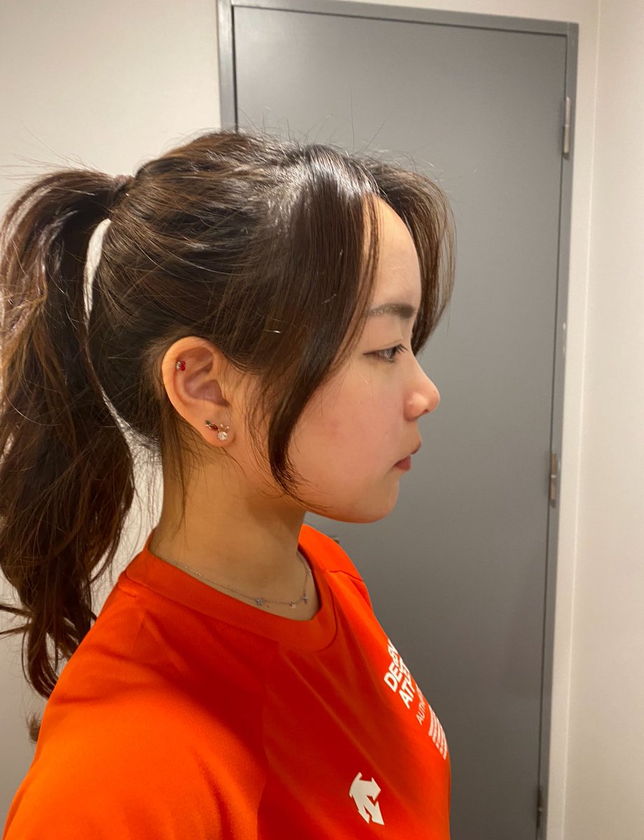 mia___tekito's tweet photo. そういえば鼻もDT1年たった。
手術直後に比べれば自然な高さだけど、術前よりはしっかり高さあっていい感じ

①矯正、両顎前(無整形)
②���顎手術1年後(ルフォー+SSRO)
③鼻整形直後(1週間)
④鼻整形1年後 https://t.co/o4Fe1xInRW