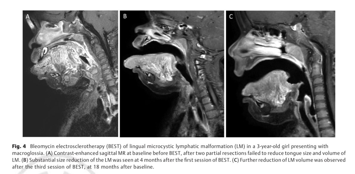 irhkch's tweet image. What’s new for vascular malformations in kids? 🔥

Check out our review article discussing  #bleomycin #electrosclerotherapy, thermal ablation &amp;amp; role of IR in the era of targeted therapy 🧬 

Link to article: researchgate.net/publication/39…

Thank you @MattHawkinsMD for inviting us!
