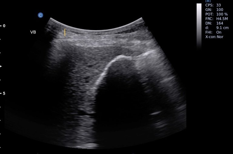 Dr. tocino (@marioalrb84_a) on Twitter photo Vesícula en porcelana
La calcificación de la pared vesicular produce una línea semilunar hiperecogénica que produce una densa sombra acústica posterior.
<a href="/JMMR83/">Joaquín Martínez</a> <a href="/ABCDEcografia/">ABCDEcografía</a> <a href="/PacoDardon/">Paco Dardón</a> <a href="/EchoTech_4/">EchoTech</a> <a href="/EcosemfyC/">EcosemFYC</a> <a href="/TaotePOCUS/">𝗗𝗮𝗻𝗶𝗲𝗹</a> Vesícula en porcelana
La calcificación de la pared vesicular produce una línea semilunar hiperecogénica que produce una densa sombra acústica posterior.
<a href="/JMMR83/">Joaquín Martínez</a> <a href="/ABCDEcografia/">ABCDEcografía</a> <a href="/PacoDardon/">Paco Dardón</a> <a href="/EchoTech_4/">EchoTech</a> <a href="/EcosemfyC/">EcosemFYC</a> <a href="/TaotePOCUS/">𝗗𝗮𝗻𝗶𝗲𝗹</a>