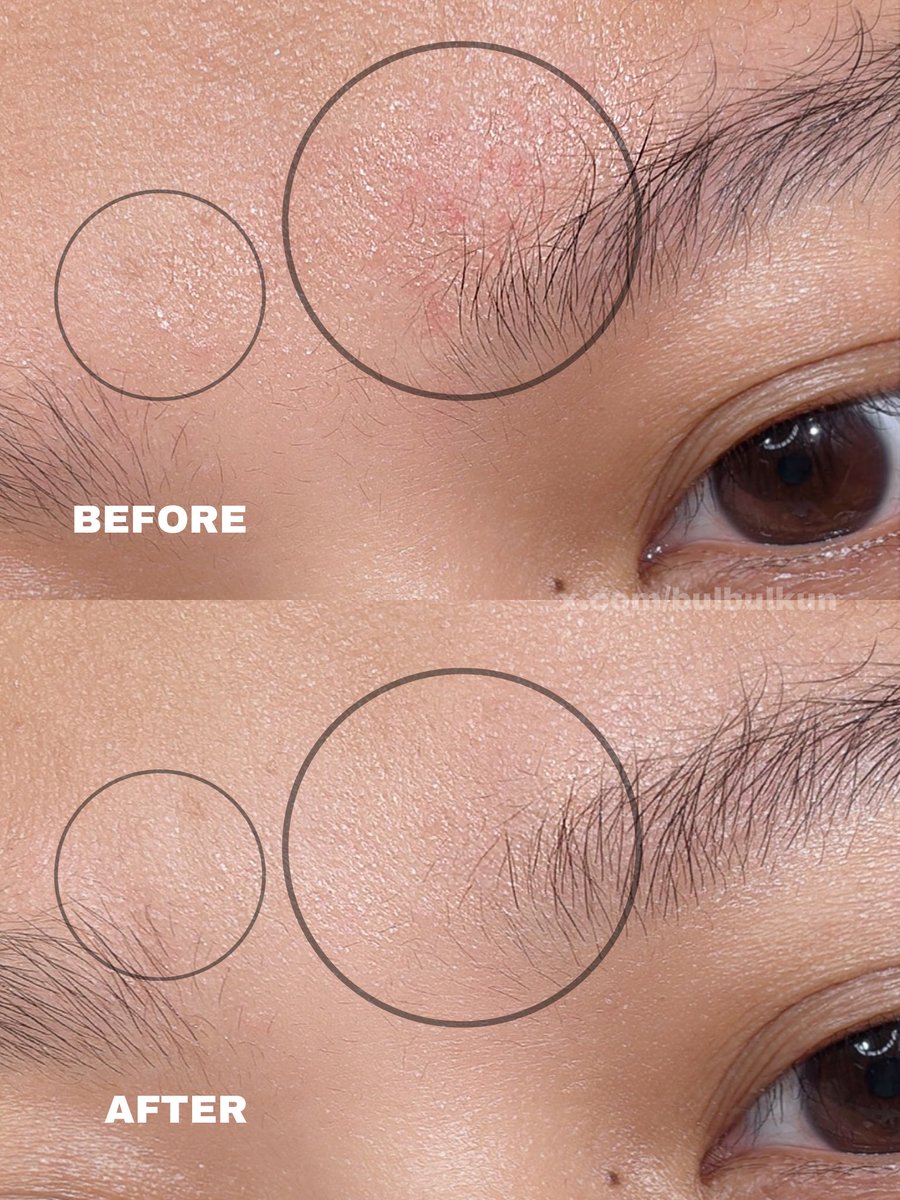 Pantes aja HOCL Spray ini lagi hype banget di luar negeri!! Modal semprot-semprot doang, bakteri jerawat langsung pada metong dalam 20 detik, rednessnya juga ikutan buyar!😙🤏

Untung udah ada versi lokalnya, harganya affordable pula~☺️