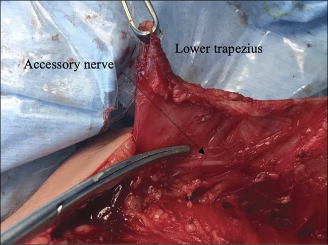 New findings on: Clinical outcome of lower trapezius muscle transfer in Birth Brachial Plexus Palsy are changing the game! bit.ly/4dB2nUv