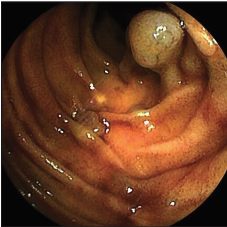 REEDigestivas_'s tweet photo. 📌Cavernous hemangioma of the jejunum
📖 Small bowel hemangiomas cause 5–10 % of benign SB lesions, often with acute GI bleeding
#PictoREED #GIbleed #CapsuleEndoscopy #SmallBowel #MIR2025
👉 https://t.co/HmZFSsUWzA https://t.co/pi7HTifwfa