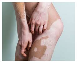 Hoy es el día mundial del vitíligo
#vitiligoday #VitiligoAwareness #vitiligo 
Trabajamos para desarrollar soluciones individualizadas que ayuden a mejorar la calidad de vida y el bienestar de quienes viven con vitíligo.