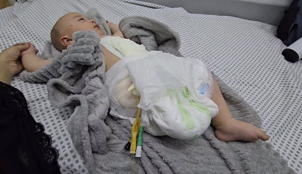 bisannowda's tweet image. Hani Ziara is a five-month-old baby. He was born in the war and lost his leg before he took his first step in this world. He knew pain before he knew how to walk on his feet, of which only one remains. His mother was breastfeeding him when a missile fell. She survived, while he