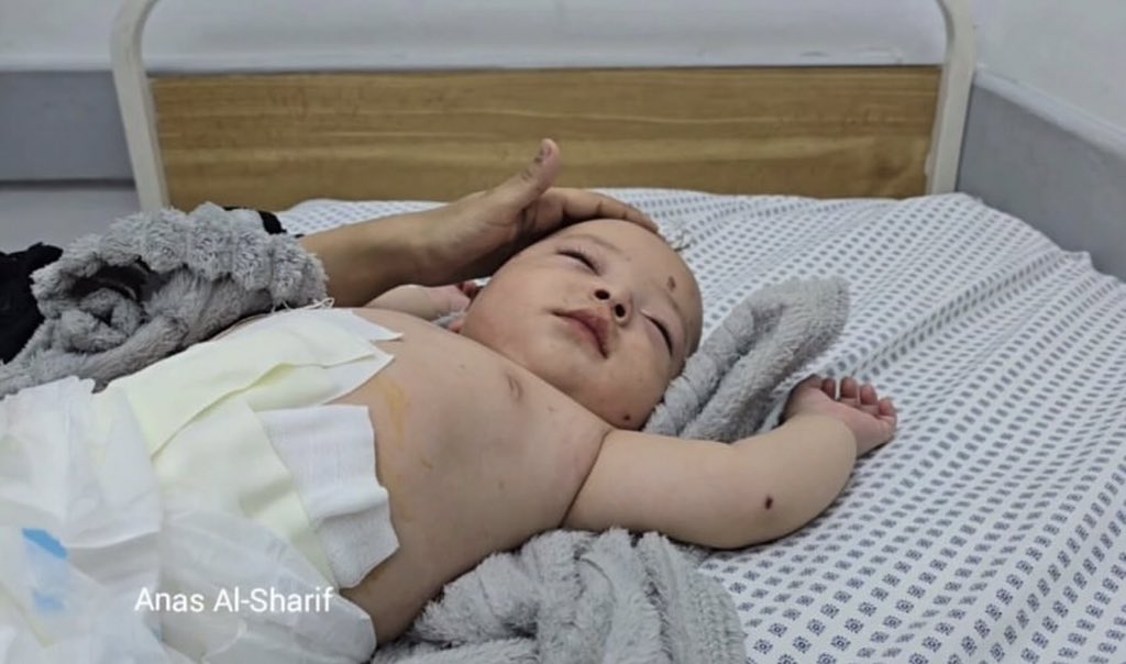bisannowda's tweet image. Hani Ziara is a five-month-old baby. He was born in the war and lost his leg before he took his first step in this world. He knew pain before he knew how to walk on his feet, of which only one remains. His mother was breastfeeding him when a missile fell. She survived, while he