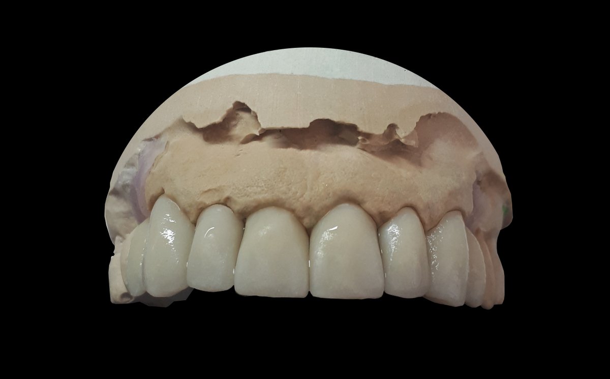 TheLabProtesis's tweet image. Dentadura completa en Zirconia Prettau, diseño y calidad excepcionales.  ¿Quieres contratar nuestros servicios? No dudes en llamarnos.

#TheLabMadrid