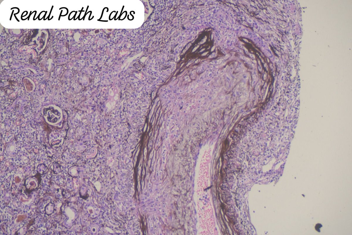 RenalPathLabs's tweet image. Images say it all. The disease,the process,possible culprit, the misery of that organ system & about the nicely done stain..Residents,want to describe this pic?Native Bx
#PathoResidents #NephrologyResidents #PathTwitter #Nephtwitter #AskRenal #RenalPathLabsGurugram @Renalpathsoc